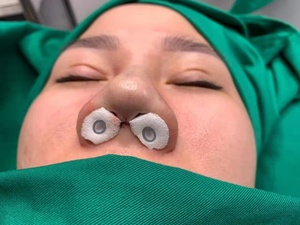 Vendaje de PVA de embalaje nasal ENT esterilizado con/sin Airtube 4,5/8/10cm para cirugía de nariz tapón de sangrado equivalente Merocel - Product Image 2