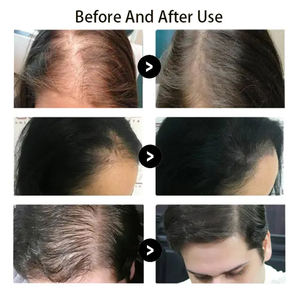 Suero <span class=keywords><strong>para</strong></span> <span class=keywords><strong>el</strong></span> <span class=keywords><strong>Cabello</strong></span> con Infusión <span class=keywords><strong>de</strong></span> Folículos Pilosos, 5 Viales, Suero con PDRN, <span class=keywords><strong>Colágeno</strong></span>, Células Madre, Factor <span class=keywords><strong>de</strong></span> Crecimiento Capilar, <span class=keywords><strong>Ampollas</strong></span> <span class=keywords><strong>de</strong></span> Suero <span class=keywords><strong>para</strong></span> <span class=keywords><strong>el</strong></span> <span class=keywords><strong>Cabello</strong></span> - Product Image 6