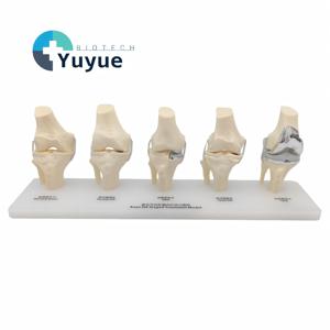 Modèle de comparaison d'implants totaux unicompartimentaux pour l'<span class=keywords><strong>arthrose</strong></span> du genou à 5 stades, modèle de traitement progressif - Product Image 1