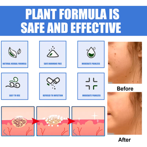 Crema OEM para el tratamiento de las verrugas, cuello, etiqueta para la piel, axila, verrugas planas, genitales, PIES, callos, crema, pomada para eliminar verrugas - Product Image 3