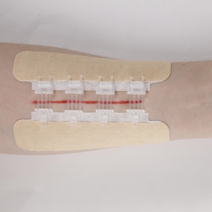 Dispositif de fermeture de plaie à fermeture éclair médicale pour les urgences - Product Image 5