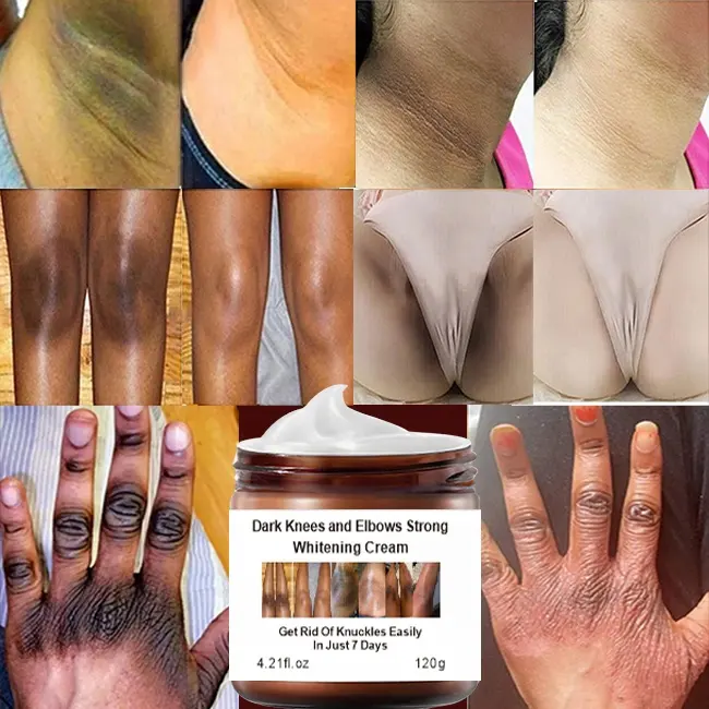 Skin New Arrival Niacinamide Dark Knees Knuckles Elbows Armpit Whitening Cream Woman Private Parts Bleaching Cream For Dark Skin