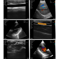 Sistema de ultrasonido de matriz en fase inalámbrico Suresult para uso médico de múltiples manijas Doppler de color