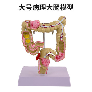 Modèle de simulation pédagogique de la pathologie du côlon, spécimen de lésion colorectale, communication médecin-patient sur les intestins, organe humain - Product Image 2
