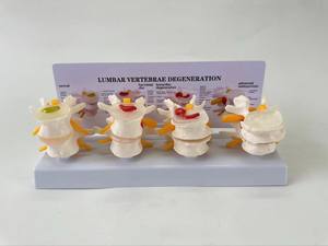 Modello di Colonna Vertebrale Lombare Patologica Umana a 4 Stadi, Modello Realistico di Lesioni della Colonna Lombare, Strumento Didattico Medico - Product Image 2