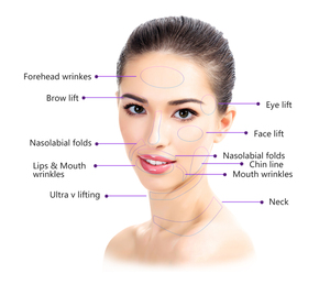 <span class=keywords><strong>Hilos</strong></span> <span class=keywords><strong>de</strong></span> PCL con púas 4D tipo L <span class=keywords><strong>de</strong></span> 18G y 100mm para lifting facial en clínicas médicas - Product Image 6