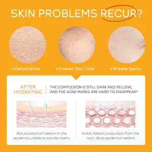 Conjunto hidratante para cuidados com a pele, vitamina C, 5 peças, tratamento anti-acne, remove marcas de acne, remove marcas de acne, conjunto de cuidados com a pele