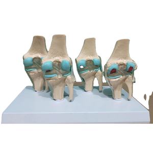 Fabrieks Menselijk Skelet Anatomisch Bot Leermodel 4-Stage Zieke Kniegewrichtsmodel - Product Image 1