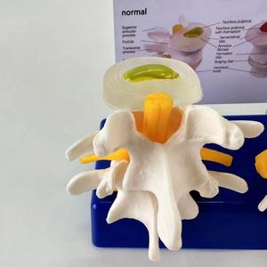 แบบจำลองการบีบอัดหมอนรองกระดูกที่แตกหักแบบสี่ขั้นตอน ตั้งแต่สุขภาพดีไปจนถึงภาวะหมอนรองกระดูกที่แตกหัก - Product Image 4