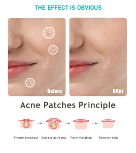 Parches Nocturnos para el Acné y Granos Profundos - 72 Parches con Ácido Salicílico e Hidrocoloide Mientras Duermes - Despierta con una Piel Más Clara - Product Image 4