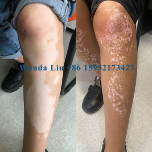 Lâmpada uvb altamente avançado para vitiligo best selling <span class=keywords><strong>Kernel</strong></span> Desk-Top Vitiligo UVB lâmpada para o tratamento da psoríase Light Therapy - Product Image 4