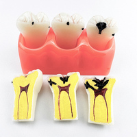 Modèle anatomique détachable 4x agrandi pour l'éducation et l'enseignement sur les caries dentaires, usage en soins bucco-dentaires, CE/ISO