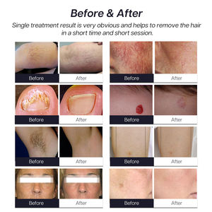 <span class=keywords><strong>Laser</strong></span> Alexandrite 755 High Power 5000W Long Pulse 1064nm ND Yag untuk Penghilangan Rambut Permanen - Product Image 6