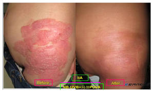 Lámpara de Fototerapia UVB KN-4006BL 311nm para Tratamiento de Vitiligo y Psoriasis, <span class=keywords><strong>Crema</strong></span> para Fototerapia, Máquina de Terapia de Luz UV - Product Image 6