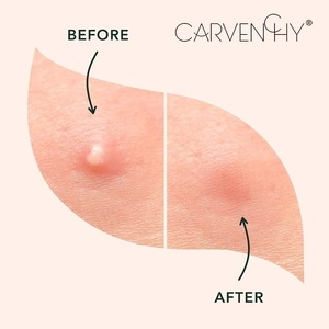 Patch anti-boutons hydrocolloïde miracle chinois <span class=keywords><strong>Rael</strong></span>, revitalisant cutané végétalien, invisible, à la vitamine C et à l'aloe vera, pour le visage - Product Image 3