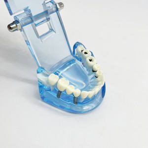 Modèle de réparation bleu école de médecine restauration des nerfs dentaires modèle humain modèle dentaire médical - Product Image 5