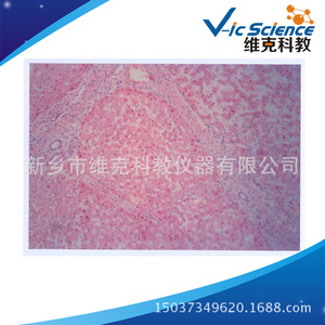 Liver cirrhosis, medical histology, digestive system diseases, biological slides, <b>microscope</b> slides - Product Image 5