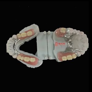 กรอบโลหะฟันปลอมบางส่วนที่ถอดออกได้ได้รับความนิยมมีความเสถียรและการเก็บรักษา (โคบอลต์และโครเมี่ยม) - Product Image 3