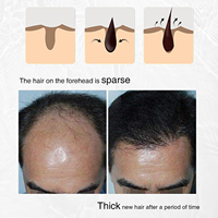 Label pribadi OEM bawang Rosemary ekstrak biji hitam semprotan penumbuh rambut rontok mencegah rambut berminyak cairan perawatan kulit kepala