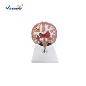 Patologías cerebrales Modelo médico Anatomía humana básica Modelos anatómicos y médicos Ciencia médica Órgano humano Cerebro patológico - Product Image 1