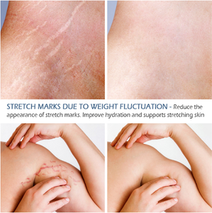 Coccodrillo Smagliature Crema di Rimozione Ance Di Maternità Riparazione Anti Invecchiamento Chiocciole Rassodante Cura Del Corpo Gravidanza Cicatrici - Product Image 5