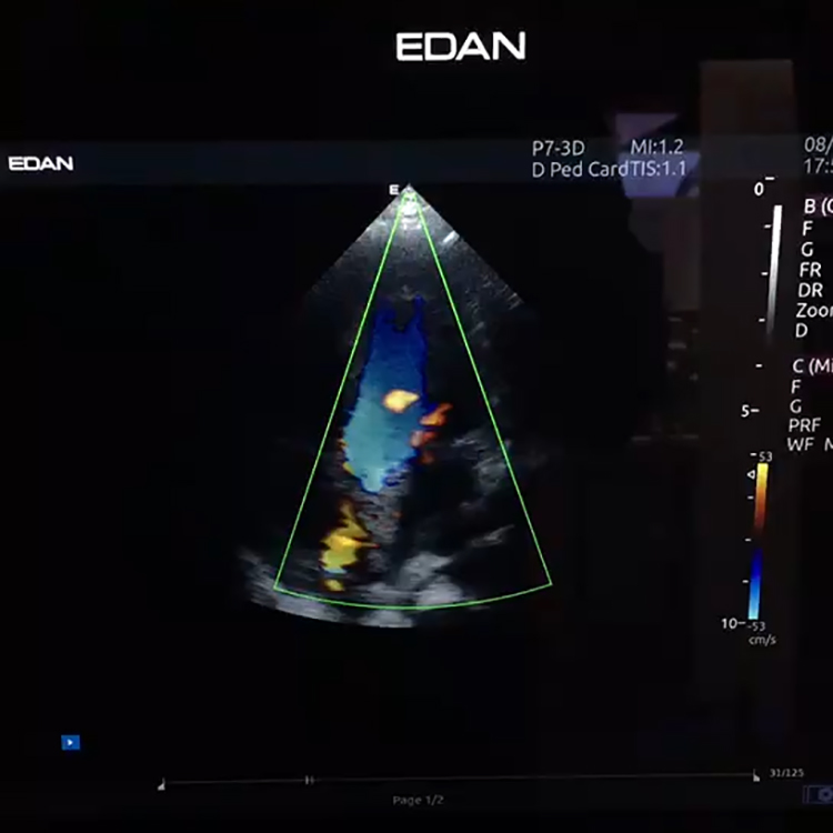 Instrumento de diagnóstico médico de alta gama monitor basculante y giratorio Edan Acclarix AX8 ultrasonido para humano y veterinario