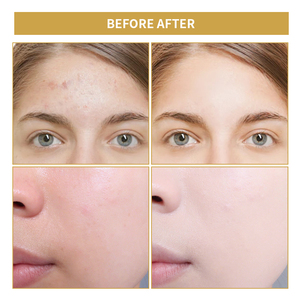 Soins de la peau au curcuma en marque privée, vitamine C naturelle, anti-acné, soin éclaircissant du visage - Product Image 4