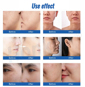 Hydro nước AQUA dermabrasion lột máy Oxy máy bay phản lực Aqua oxy Peel tay khoan <span class=keywords><strong>6</strong></span> trong 1 mặt hydrodermabrasion - Product Image 5