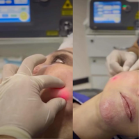 Appareil laser endo 1470 nm pour le lifting et la réduction des rides du visage