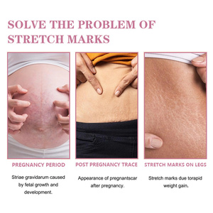 كريم إزالة علامات التمدد من ZS بالجملة، كريم ما بعد الولادة لعلاج علامات تمدد البطن والفخذين والساقين والأرداف والصدر للحوامل والنساء - Product Image 4