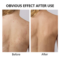 Spray anti-acné hydratant sans tache pour le corps et le dos, marque privée