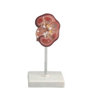 Modèle pédagogique de calcul rénal pour l'enseignement en urologie - Product Image 4
