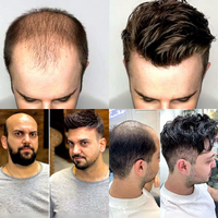 Prothèse capillaire ultra-fine de 0,03 mm pour hommes, système de remplacement capillaire Remy à boucles en V, ligne de cheveux indétectable, postiche naturel pour hommes
