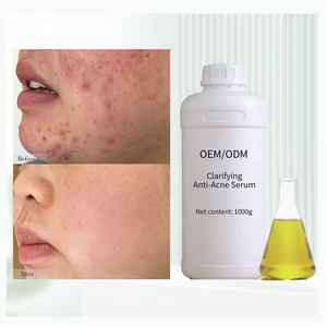 Esencia Herbal Profesional para el Acné, Material Prima para Reparación <span class=keywords><strong>de</strong></span> Marcas <span class=keywords><strong>de</strong></span> Acné y Comedones Cerrados, Venta <span class=keywords><strong>al</strong></span> <span class=keywords><strong>Por</strong></span> <span class=keywords><strong>Mayor</strong></span> - Product Image 1