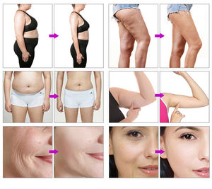 벨라 M30 기계식 진공 롤러 시스템 체중 감량 바디 슬리밍 바디 조형 지방 감소 기계 - Product Image 5