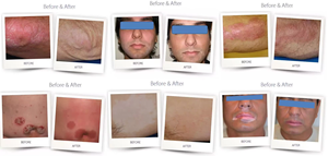 Sistema Excimer de 308nm sin Consumibles de Repuesto, Bajo Costo de Mantenimiento, para Vitiligo y Eccema - Product Image 5