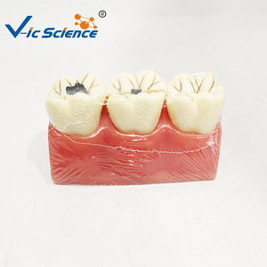 แบบจำลองสาธิตฟันผุ; สื่อการสอนเพื่อการเผยแพร่และแสดงผลทางวิทยาศาสตร์ด้านสุขภาพช่องปากและพยาธิวิทยา; การสอนทางปาก - Product Image 1