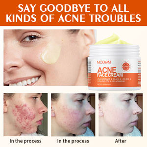 Crema para el Acné <span class=keywords><strong>de</strong></span> Marca Privada del Fabricante, Eficaz y <span class=keywords><strong>de</strong></span> Acción Rápida, con Propiedades Blanqueadoras, Ácido Hialurónico y <span class=keywords><strong>Aloe</strong></span> <span class=keywords><strong>Vera</strong></span> - Product Image 5