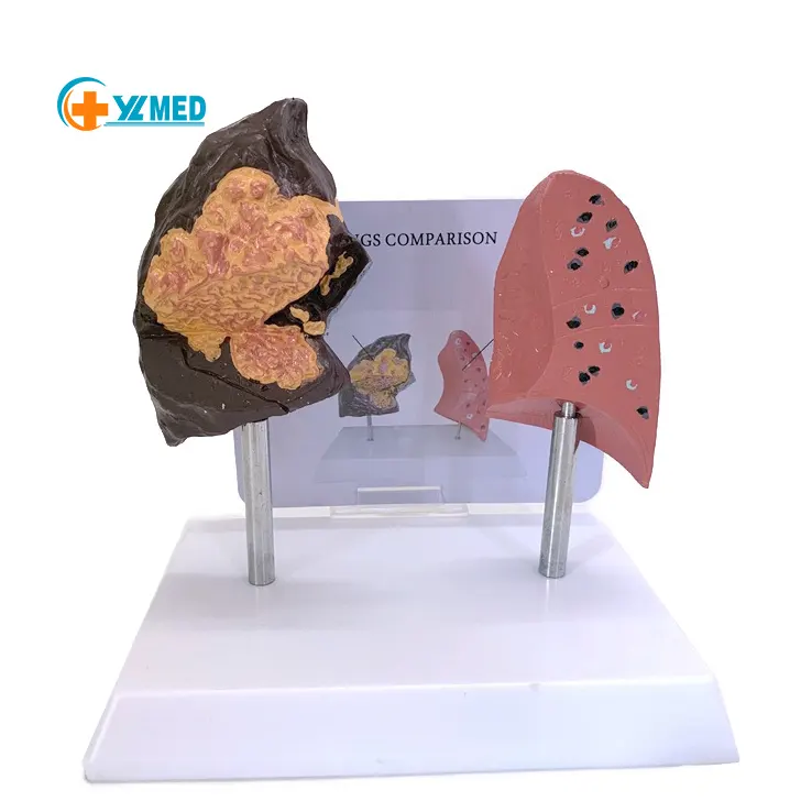 Sciences médicales Modèle anatomique Corps humain Maladies du système respiratoire Poumon fumeur humain et poumon sain Modèle comparatif