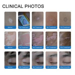 Lámpara Uvb Uv para Vitiligo Psoriasis Manchas blancas <span class=keywords><strong>Enfermedad</strong></span> DE LA <span class=keywords><strong>PIEL</strong></span> 308nm Instrumento de fototerapia ultravioleta Tratamiento de <span class=keywords><strong>eczema</strong></span> de vitiligo - Product Image 3