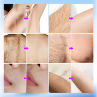 Depiladora Electrolysis 3 en 1, Permanente e Indolora, con Múltiples Agujas, para Cuerpo y Rostro, Elimina Vello Blanco y Negro