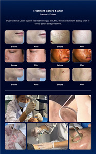 Láser Fraccional de CO2 de 10600nm para Eliminación de Cicatrices de Acné, Uso en Salón, Portátil, de Escritorio, para Lifting Facial y Reafirmación de la Piel, con Enfriamiento por Agua - Product Image 3