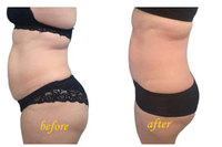 Laser Offre Spéciale 1470nm pour la peau de levage faciale serrant le dispositif approuvé de CE de liposuccion de laser