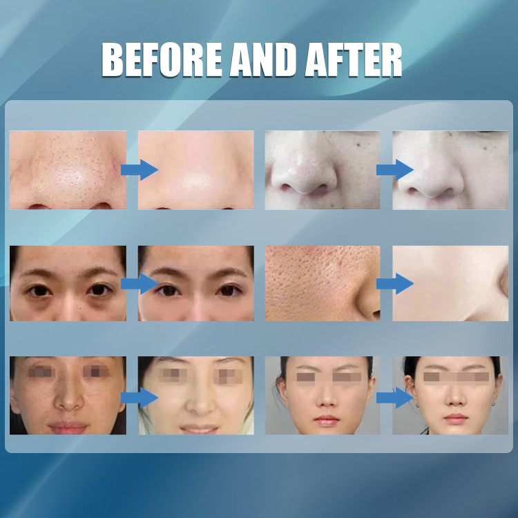 Xinlei Esthetic beauty machine