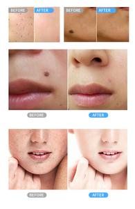 Dispositivo Non Chirurgico per la Rimozione di Fibromi Cutanei, 2 in 1 per Viso e Corpo, Terapia al Plasma Freddo con Ozono e Fibroblasti - Product Image 6