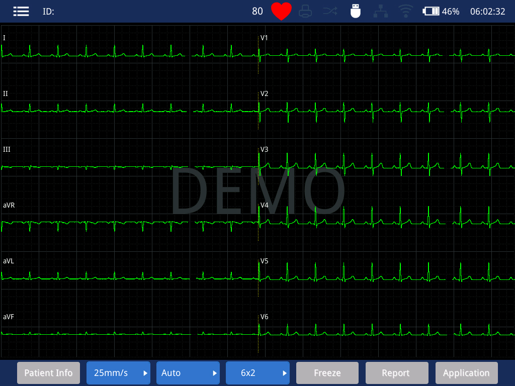 Equipo médico de alta resolución de 19 pulgadas para diagnóstico de infarto de miocardio máquina de ECG de 18 canales
