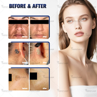 Perfectlaser - Laser picoseconde à effet photoacoustique - Élimination rapide des pigments de tatouage - Machine laser de beauté