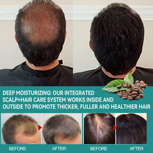 EELHOE Esencia Anticaída Hidratante para Cabello, Fortalece la Línea del Cabello, Aceite para el Crecimiento del Cabello - Product Image 6