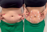 Machine de liposuccion, lifting du visage, lipolyse, élimination vasculaire, laser diode 980 1470 nm, endo, resserrement cutané, fibres canules, physiothérapie