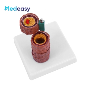 Modelo Anatómico Vascular de Cuatro Etapas de Medeasy Medical Science para el Estudio de la <span class=keywords><strong>Enfermedad</strong></span> de <span class=keywords><strong>Arteriosclerosis</strong></span> Humana - Product Image 3